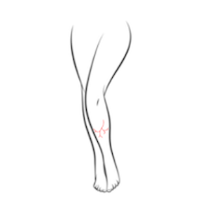 VL-FV - Leg Veins Small Area - Package of 5
