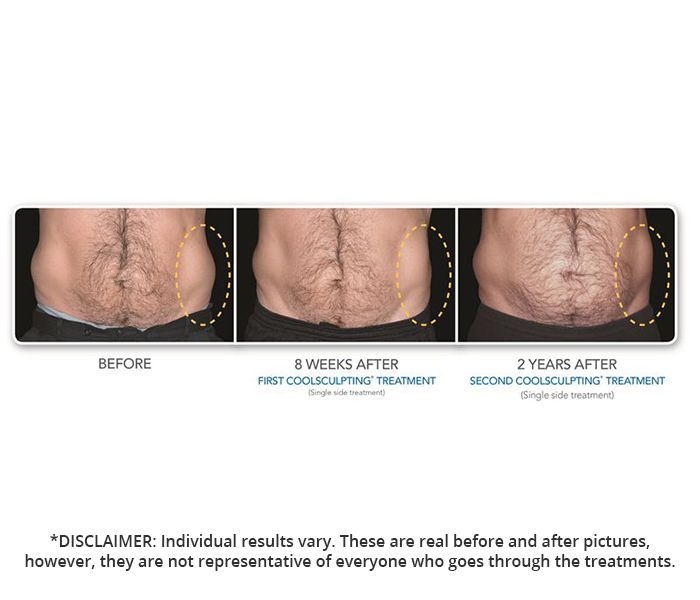 CoolSculpting