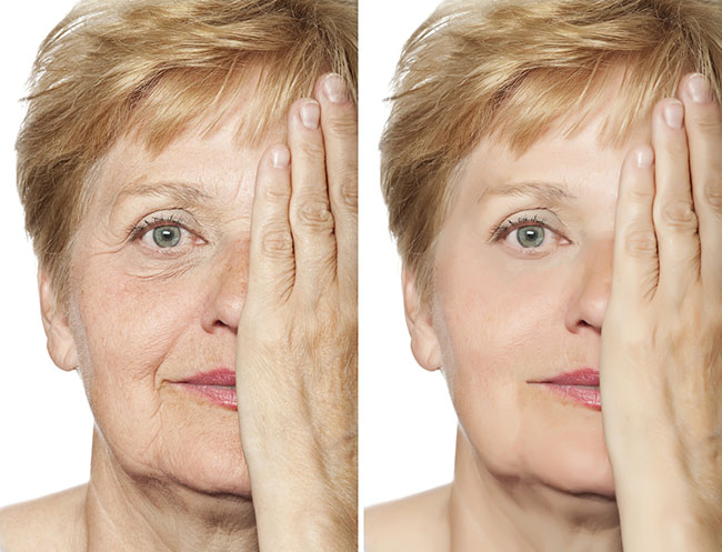 Skin Rejuvenation