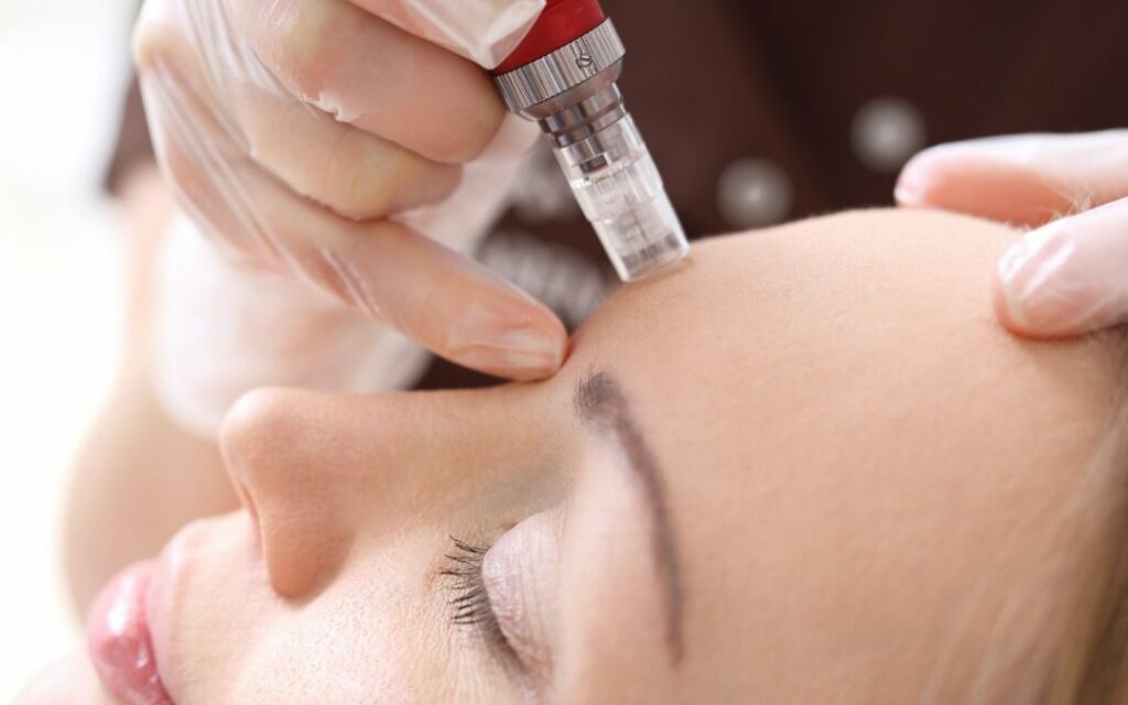 Microneedling vs. At Home Dermaroller