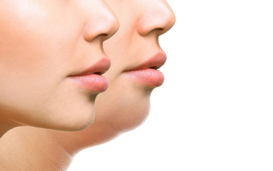 Double Chin Removal