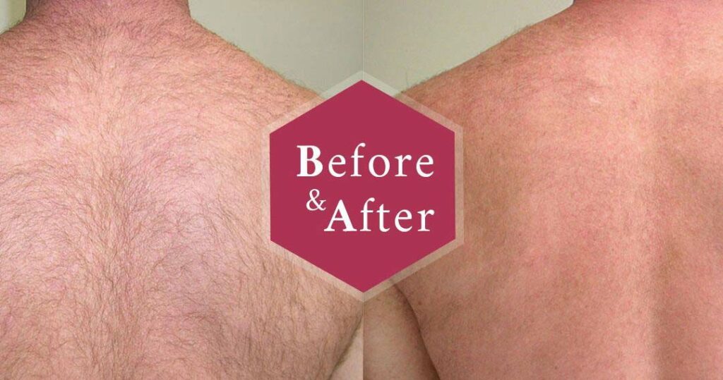Laser Hair Removal before after