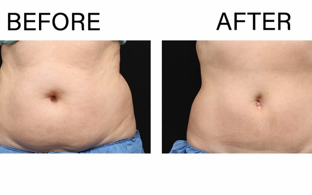 CoolSculpting