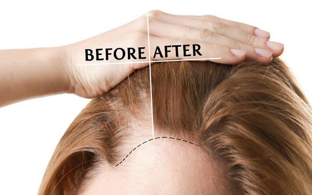 Hair Transplant Toronto
