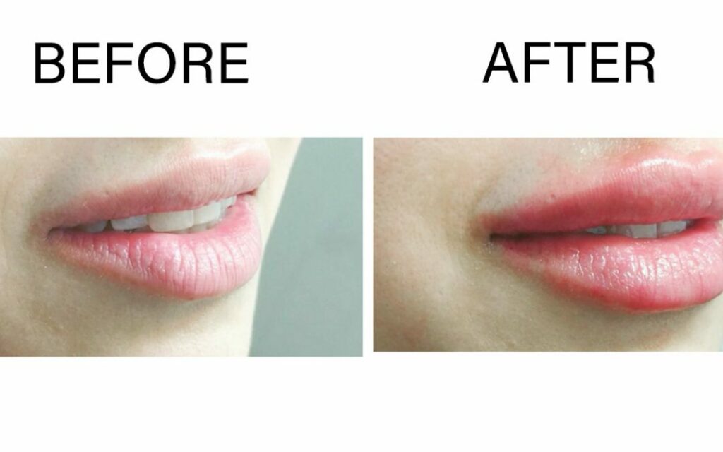 Lip Injections