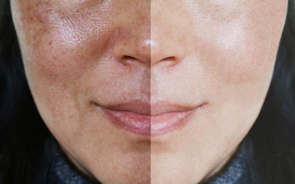 Melasma Treatment