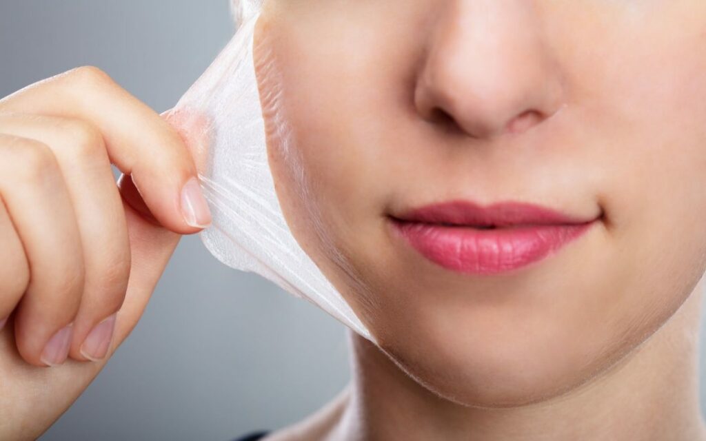 overview of Chemical Peels
