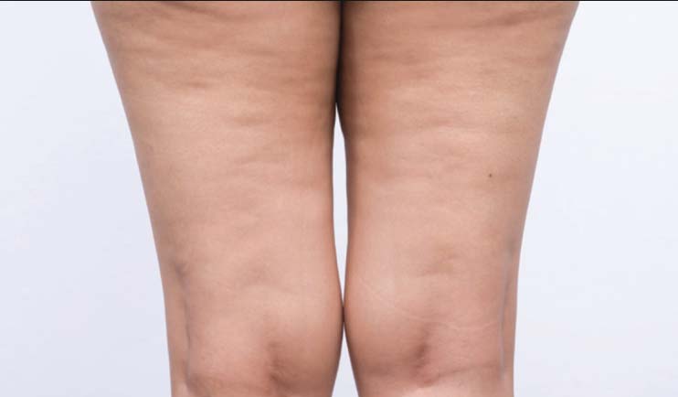 There are many reasons why women can get cellulite.