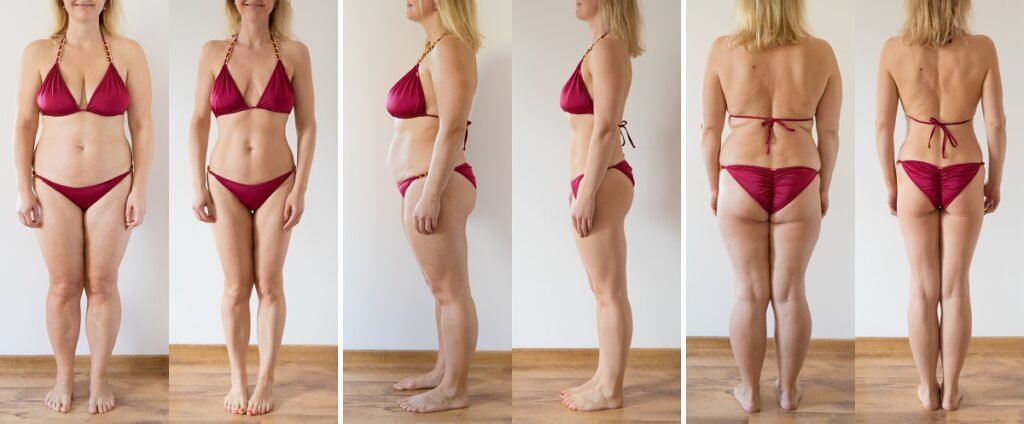 How Much is the Cost of CoolSculpting in Toronto?
