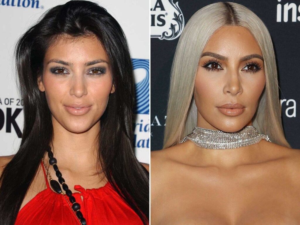 Is The Cost of Botox Worth It?