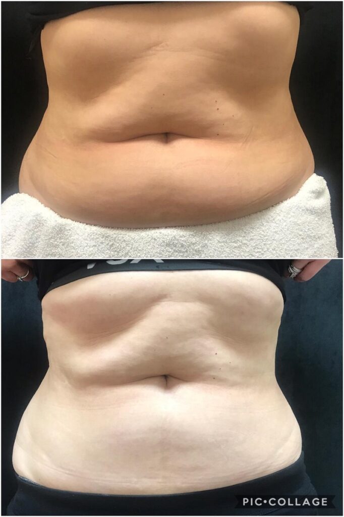 It targets specific fatty areas