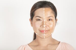 Treatment options for melasma
