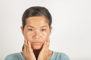 How Much Does Melasma Treatment Cost in Toronto?