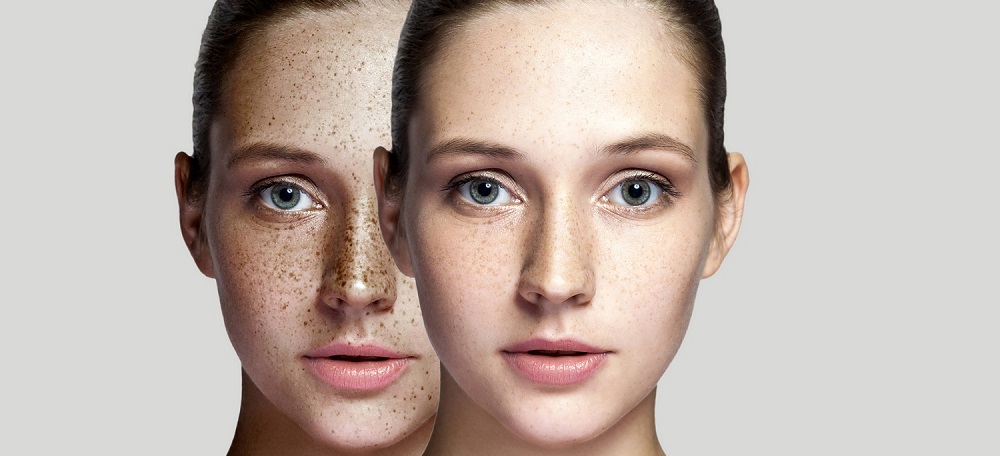 How to Get Rid of Skin Pigmentation