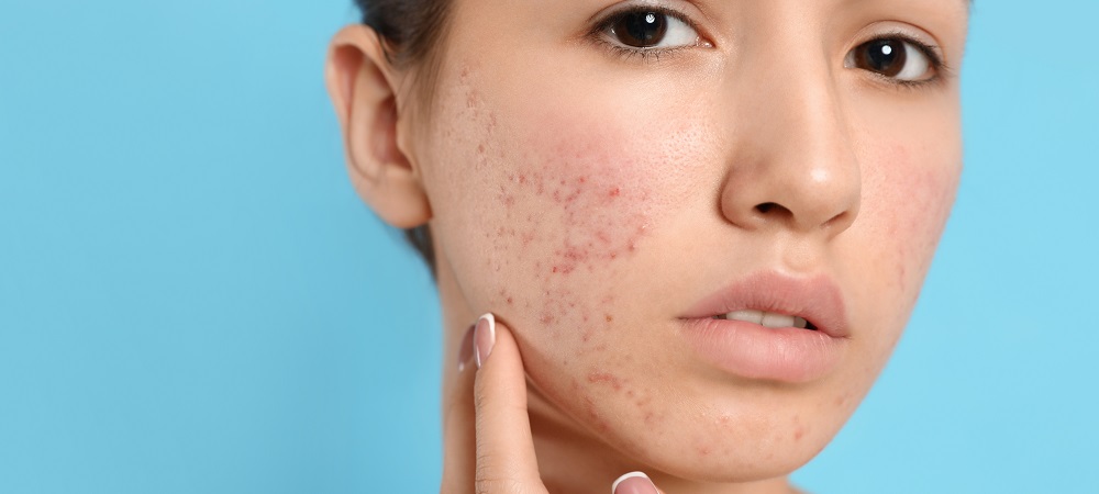 Acne and Rosacea: Know the Difference