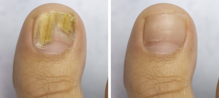 How to Treat Nail Fungus Effectively