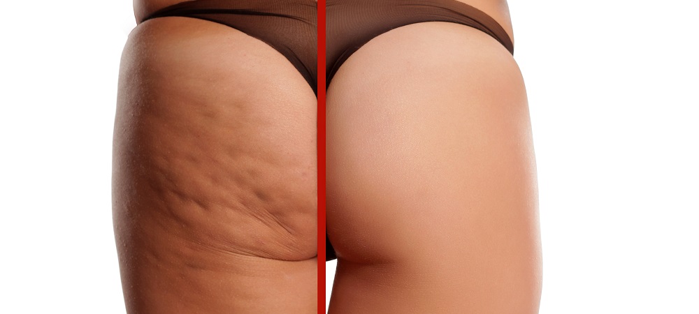 Best Treatments for Removing Cellulite