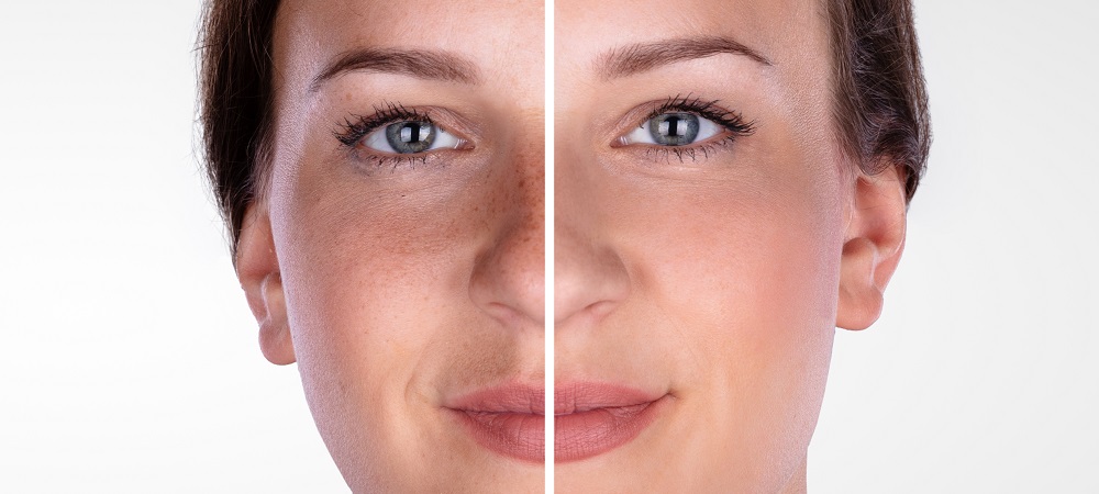 Microdermabrasion Treatment: AquaPure Facial by CanadaMedLaser