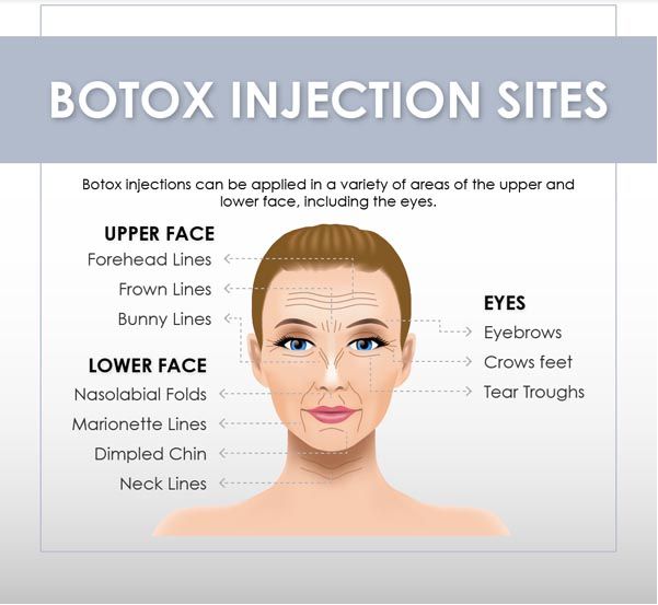 Botox Sites