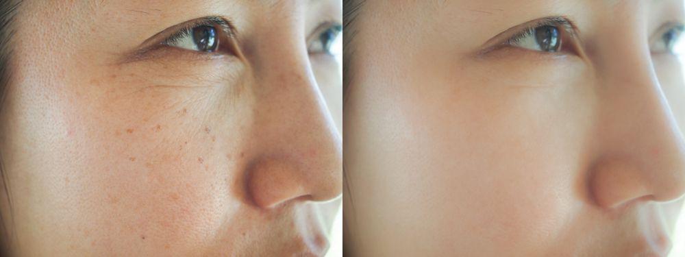 Treatment for Melasma
