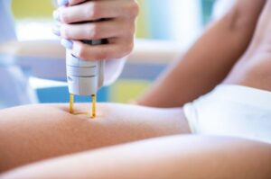 Laser Hair Removal on Legs