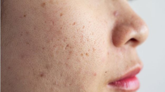 Causes of Skin Pigmentation