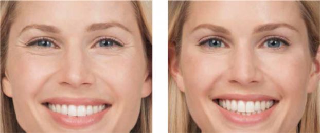 Botox Treatments in Vaughan