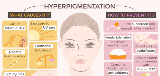 what causes pigmentation