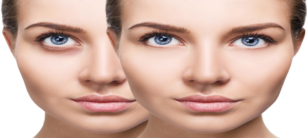 Dark Circles Treatment