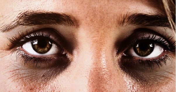 dark circles