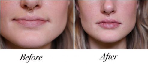 before & after Lip Injections