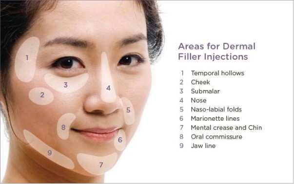 Dermal filler points