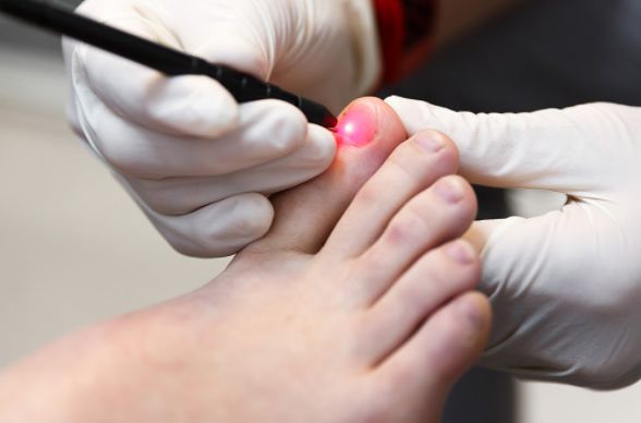 cost of laser therapy for toenail fungus