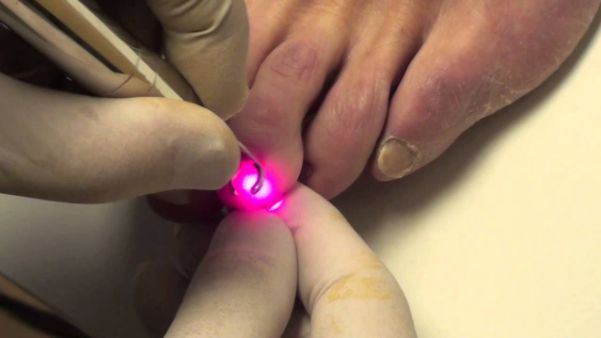 there is no downtime in the treatment