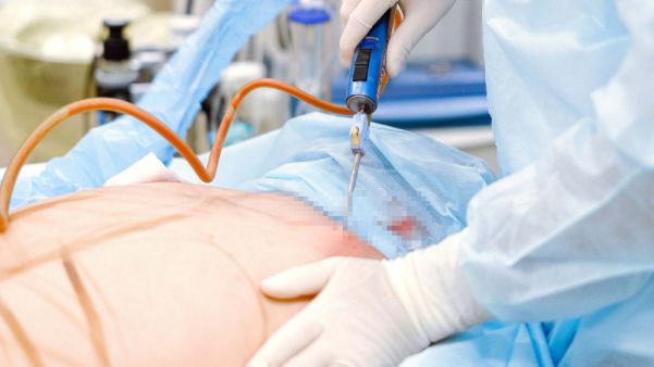 types of liposuction