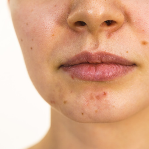 acne-and-acne-scar-removal