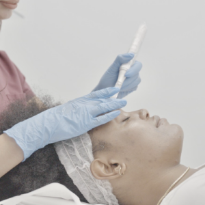 Microneedling treatment at Canada MedLaser