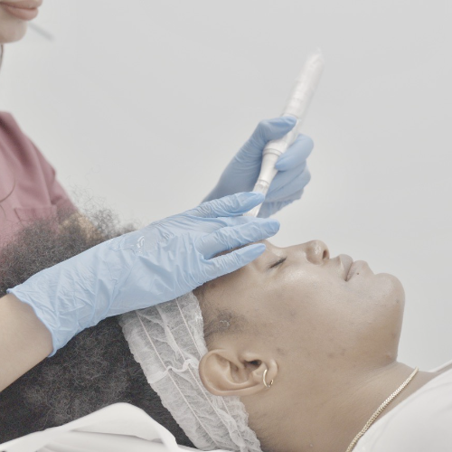 Microneedling treatment at Canada MedLaser