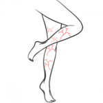 vascular-lesions