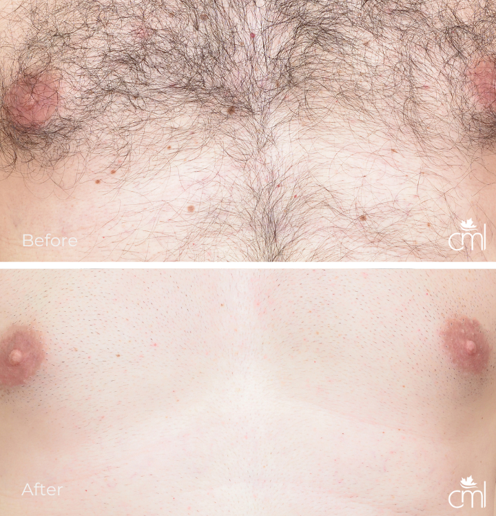 Before and After Laser hair removal treatment at Canada MedLaser