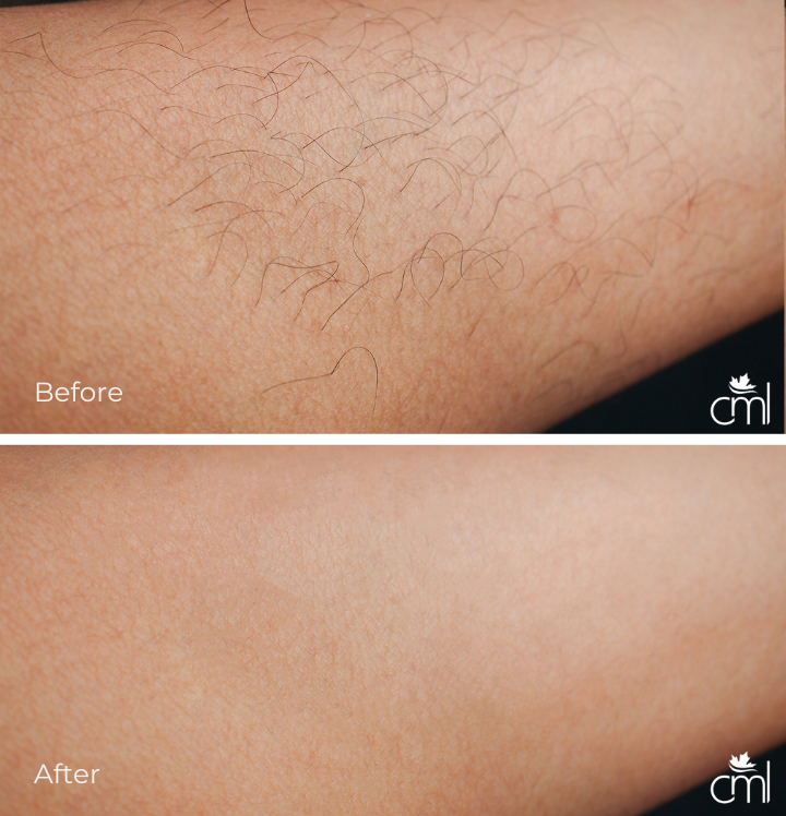 Laser hair removal on legs before and after image