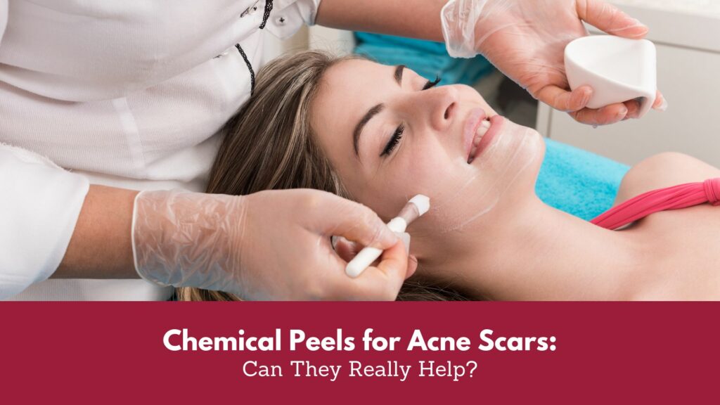 Chemical Peels for Acne Scars: Can They Really Help? Blog Cover