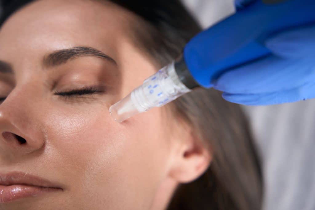 This is a microneedling blog image