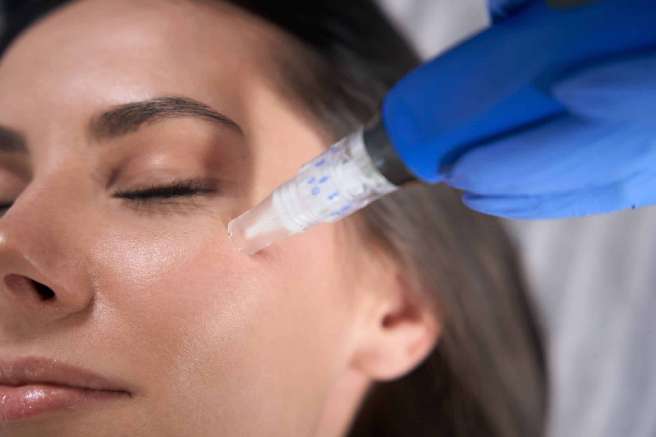 This is a microneedling blog image