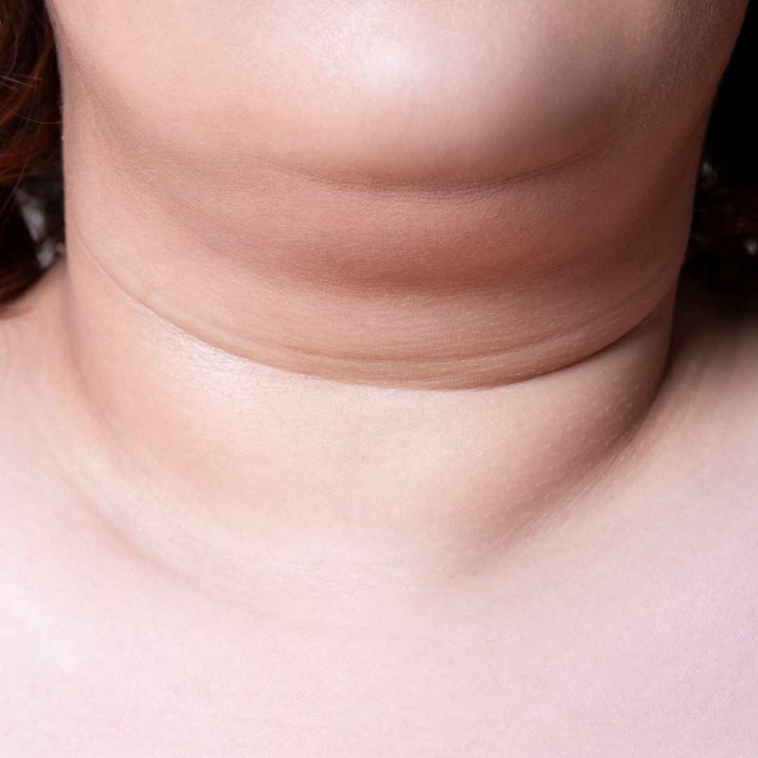 Treatments to getting rid of double chin
