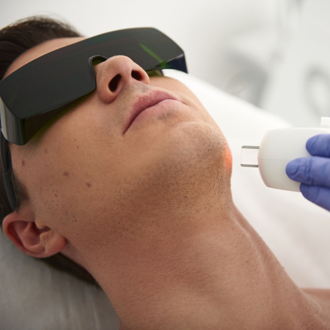 Laser Hair Removal - Facial Hair for men