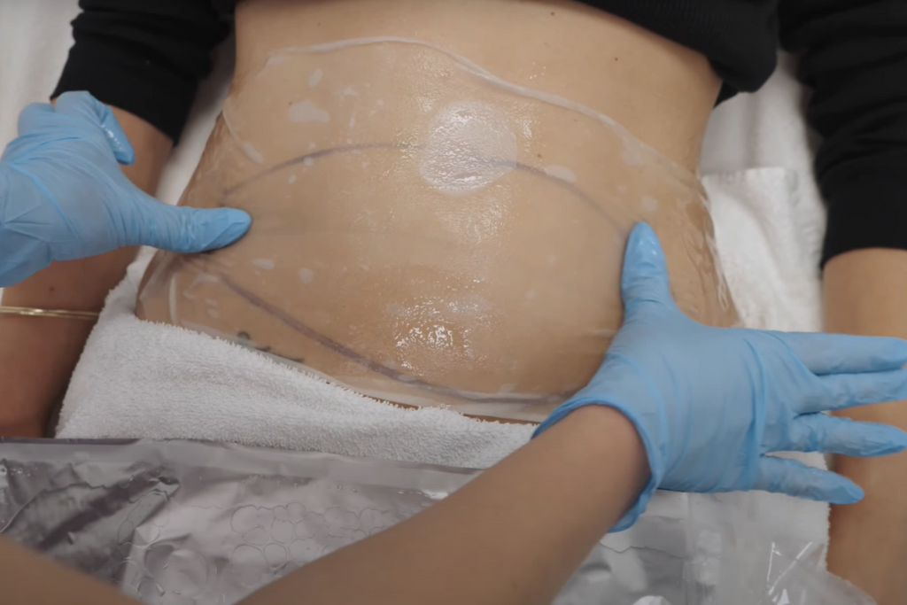 This is a Coolsculpting blog image