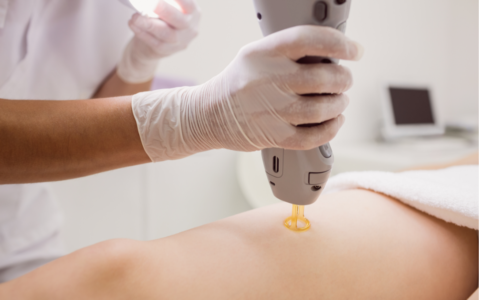 How Laser Hair Removal Works