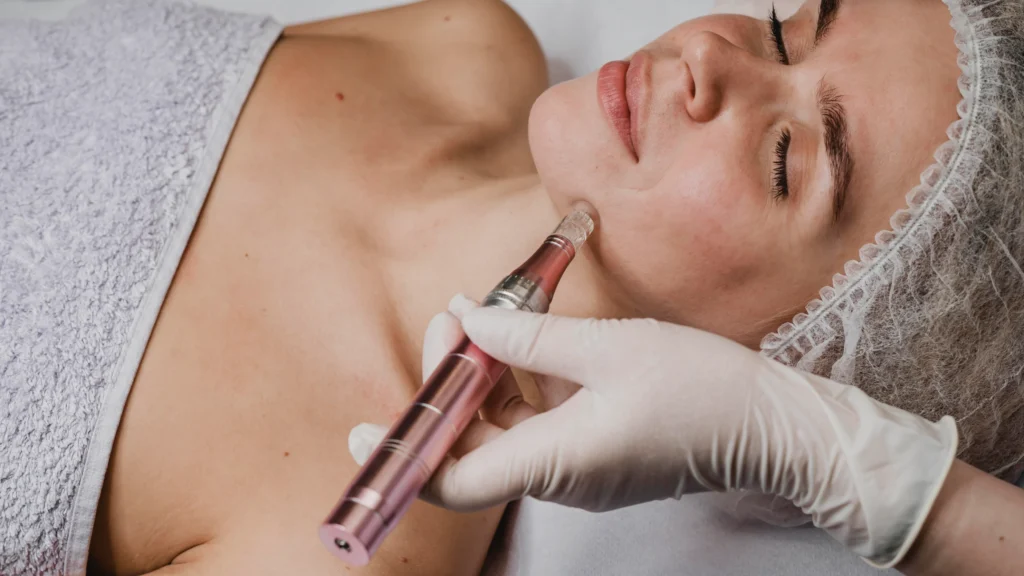 Microneedling with exosomes - woman going through treatment
