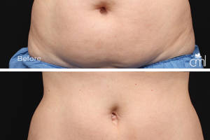 Body Contouring – Coolsculpting – Before_After – Abdomen Body Contouring Treatment before and after image
